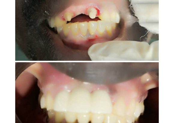 Prothèses Dentaires