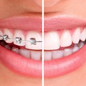 Orthodontie et Hygiène Bucco-dentaire